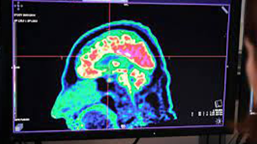 Doktor olma hayaline beyin tümörü engeli