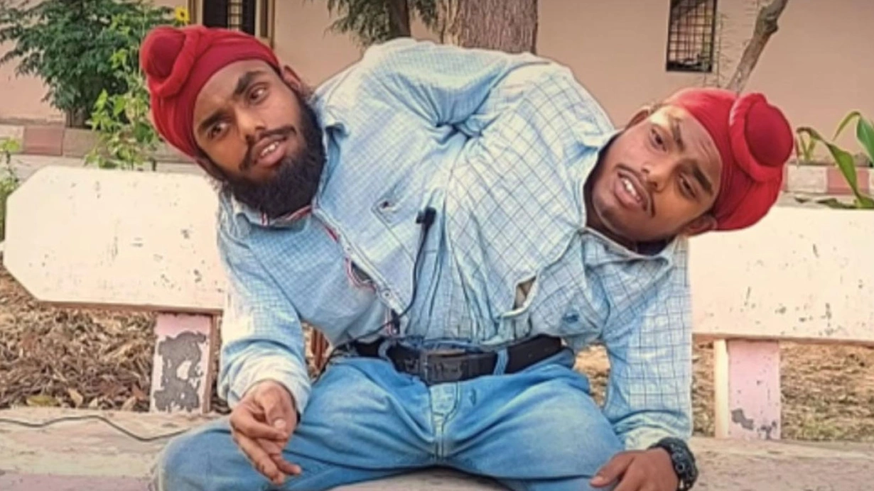 Yapışık ikizler ilk işlerini buldu: Çift maaş alacaklar